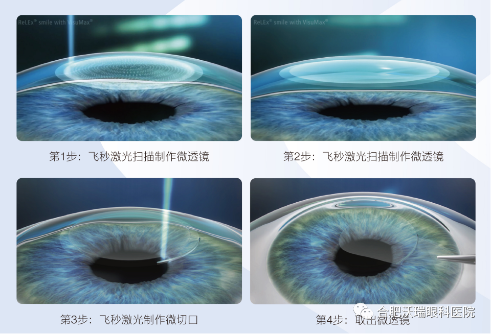 德國蔡司新一代全飛秒近視手術設備落戶合肥沃瑞眼科醫(yī)院！