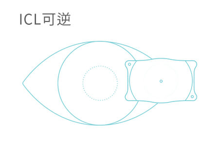 2021年做近視ICL手術(shù)多少錢(qián)？不可錯(cuò)過(guò)