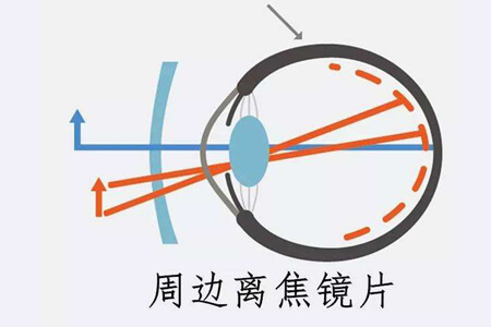 什么是周邊離焦近視控制眼鏡？周邊離焦近視眼鏡的優(yōu)缺點有哪些？