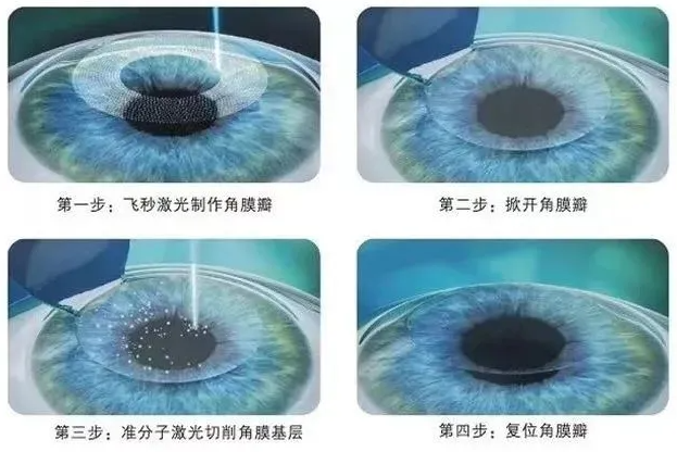 精雕半飛秒和全飛秒還有半飛秒有什么區(qū)別？